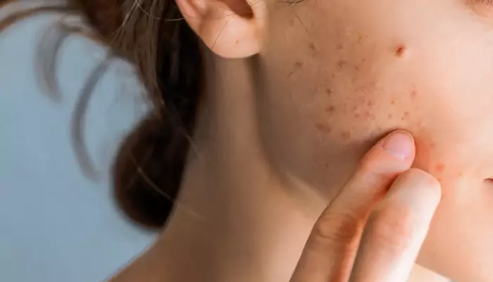 Taking Accutane For Acne – Is It Worth It? Uncovering The Answers